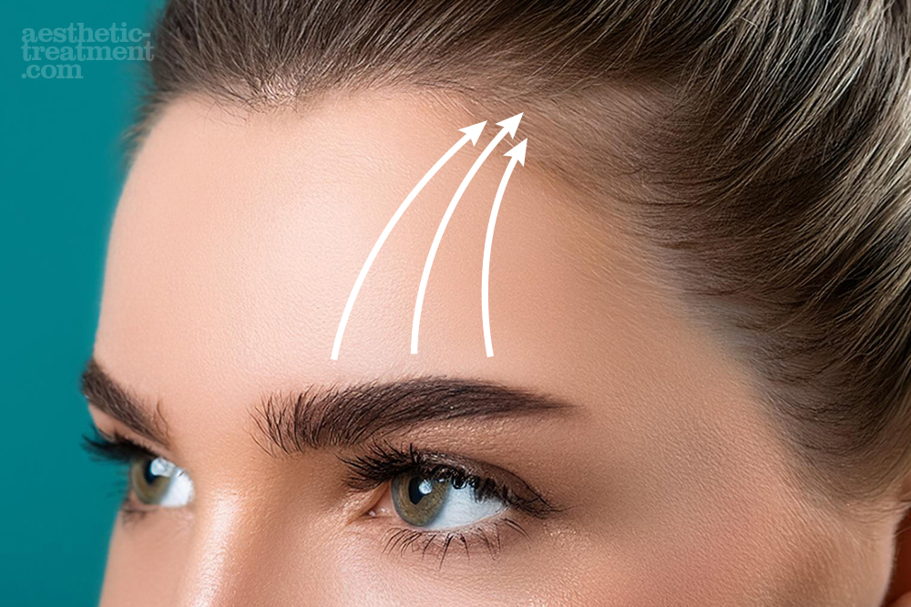brow lift threads procedure overview