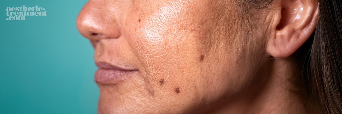 laser-skin-pigmentation-aesthetic-treatment